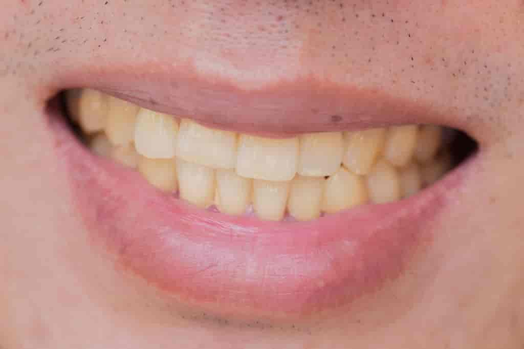 Whiten Your Teeth