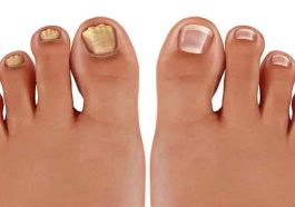 10 Popular Home Remedies for Toenail Fungus