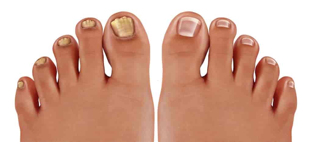 10 Popular Home Remedies for Toenail Fungus