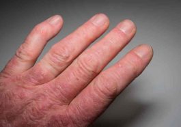 8 Signs of Psoriatic Arthritis