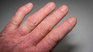 8 Signs of Psoriatic Arthritis