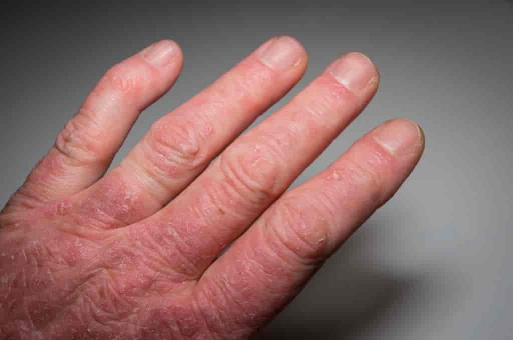 8 Signs of Psoriatic Arthritis